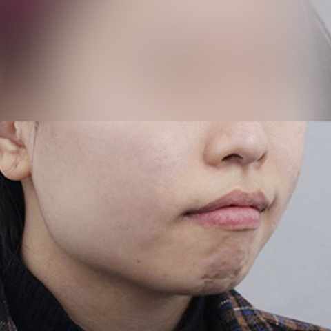 Hình ảnh sau điều trị mụn và sẹo mụn trên di động 1