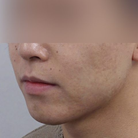 Hình ảnh sau điều trị mụn và sẹo mụn trên di động 2