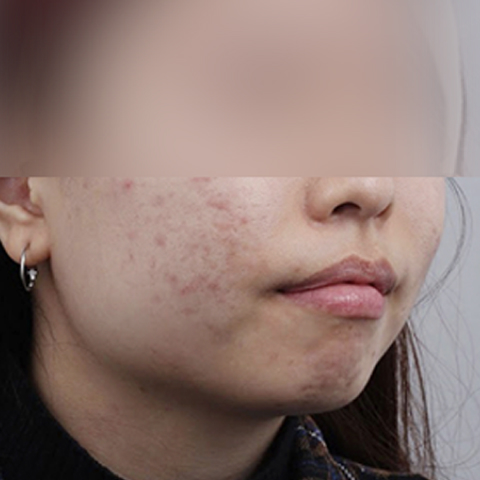 Hình ảnh trước điều trị mụn và sẹo mụn trên di động 1