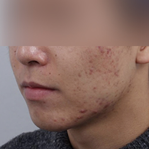 Hình ảnh trước điều trị mụn và sẹo mụn trên di động 2