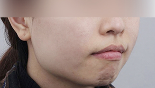 Hình ảnh sau điều trị mụn và sẹo mụn 1