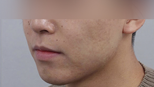 Hình ảnh sau điều trị mụn và sẹo mụn 2