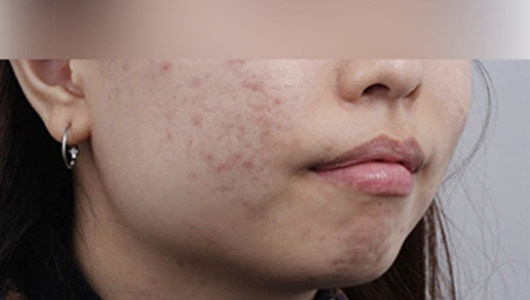 Hình ảnh trước điều trị mụn và sẹo mụn 1