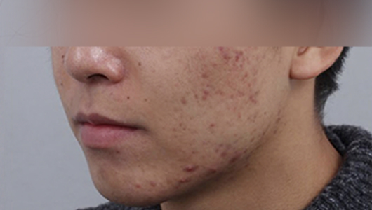 Hình ảnh trước điều trị mụn và sẹo mụn 2