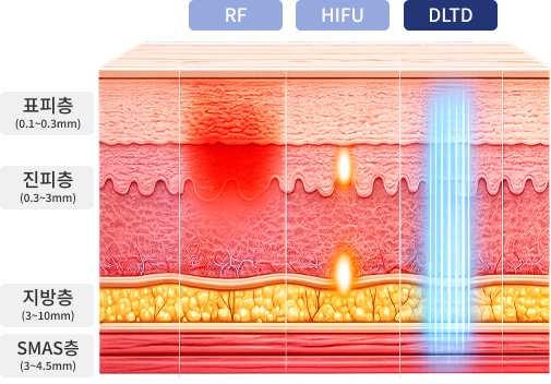 Hình ảnh so sánh lớp da mục tiêu của RF, HIFU và DLTD