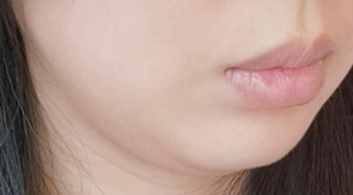 Trước khi cải thiện nọng cằm