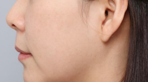 Trước khi cải thiện nếp nhăn khóe miệng