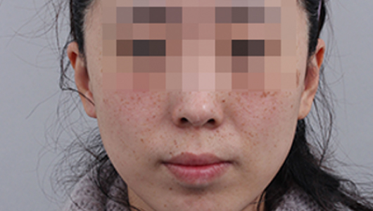 Hình ảnh trước điều trị sắc tố & làm trắng da 2