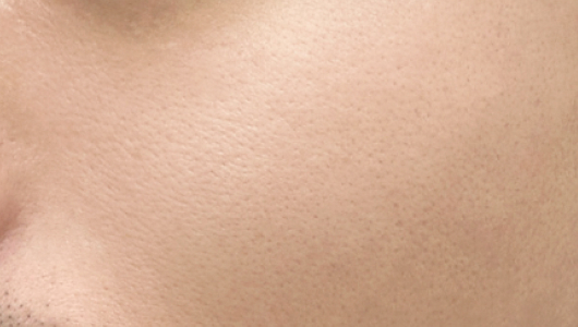 Hình ảnh sau 3 buổi điều trị Coolfase 1