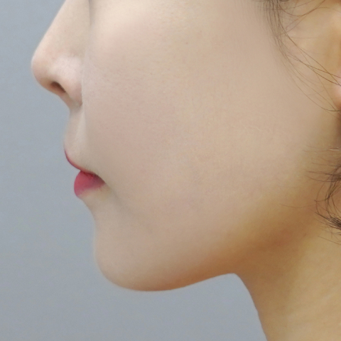 Hình ảnh sau 3 buổi điều trị Coolfase trên di động 3