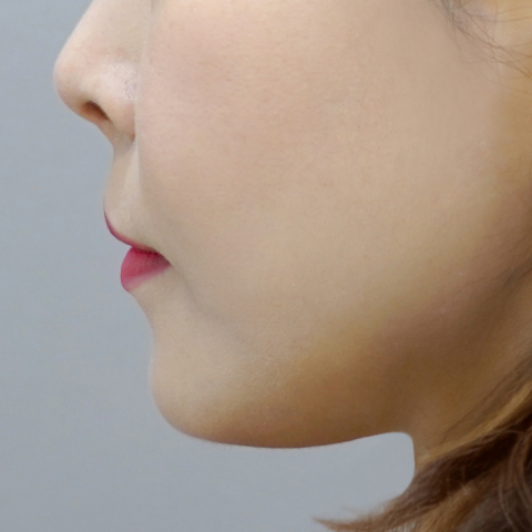 Hình ảnh trước điều trị Coolfase trên di động 3