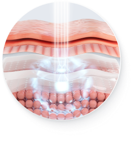 Hình minh họa cơ chế tái tạo collagen của Coolfase trên di động
