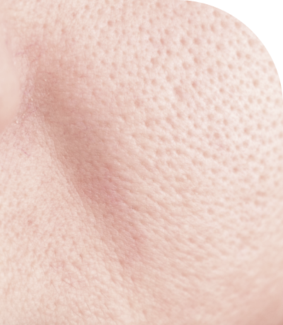 Hình ảnh điều trị thu nhỏ lỗ chân lông