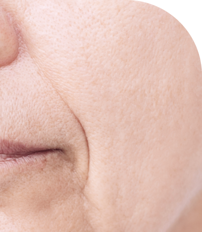 Hình ảnh điều trị cải thiện độ đàn hồi da