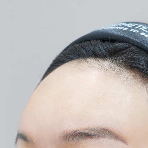 Hình ảnh sau khi tiêm filler trán tại LIENJANG trên di động 1