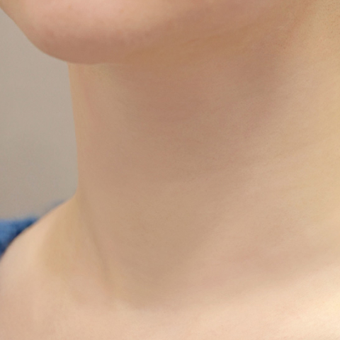 Hình ảnh sau khi tiêm filler nếp nhăn cổ tại LIENJANG trên di động