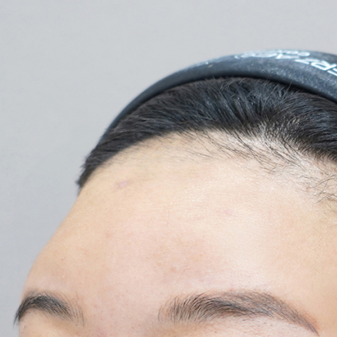 Hình ảnh trước khi tiêm filler trán tại LIENJANG trên di động 1