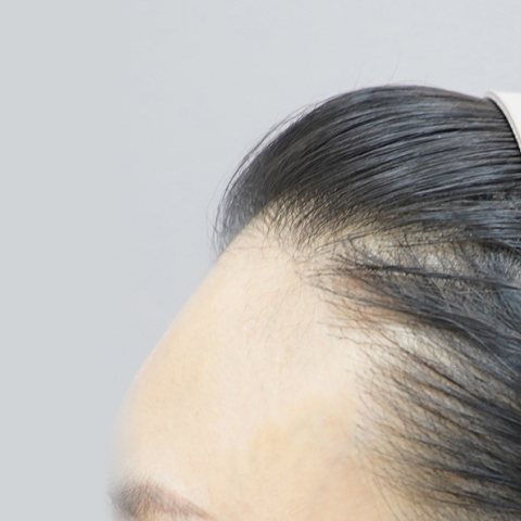 Hình ảnh trước khi tiêm filler trán tại LIENJANG trên di động 2