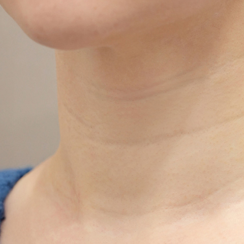 Hình ảnh trước khi tiêm filler nếp nhăn cổ tại LIENJANG trên di động