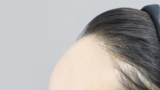 Hình ảnh sau khi tiêm filler trán tại LIENJANG 2