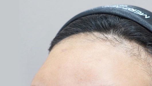 Hình ảnh trước khi tiêm filler trán tại LIENJANG 1