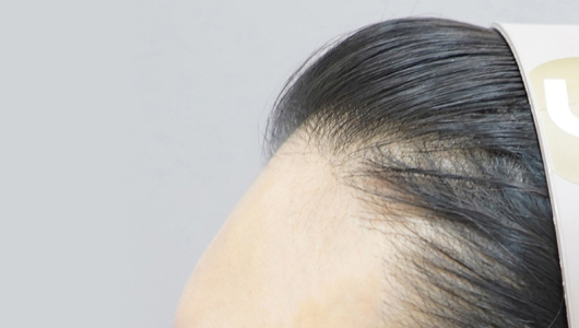 Hình ảnh trước khi tiêm filler trán tại LIENJANG 2