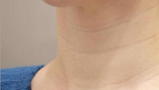 Hình ảnh trước khi tiêm filler nếp nhăn cổ tại LIENJANG