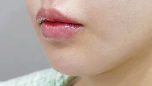 Ngay sau khi tiêm filler môi (Kiểu môi chảy xệ)