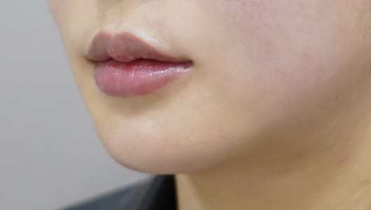 Ngay sau khi tiêm filler môi (Kiểu môi bất đối xứng)