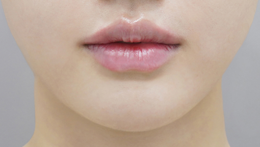 Ngay sau khi tiêm filler môi (Kiểu môi nhỏ)