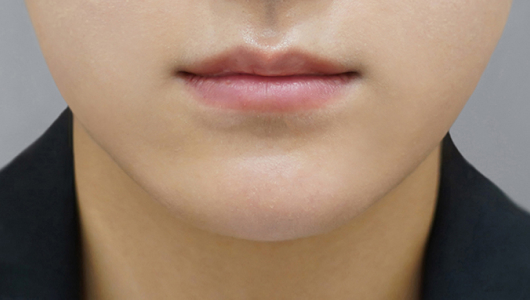 Trước khi tiêm filler môi (Kiểu môi mỏng)