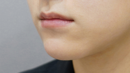 Trước khi tiêm filler môi (Kiểu môi mỏng)