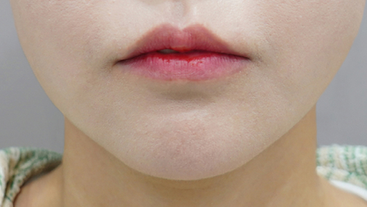 Trước khi tiêm filler môi (Kiểu môi chảy xệ)