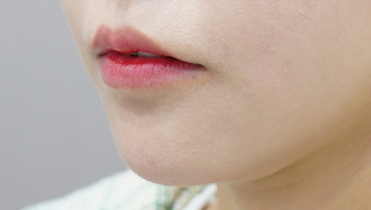 Trước khi tiêm filler môi (Kiểu môi chảy xệ)