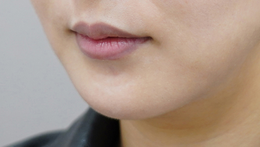 Trước khi tiêm filler môi (Kiểu môi bất đối xứng)