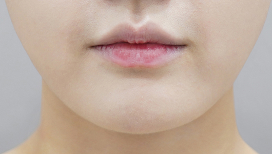 Trước khi tiêm filler môi (Kiểu môi nhỏ)