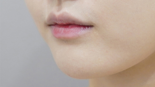Trước khi tiêm filler môi (Kiểu môi nhỏ)