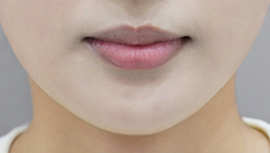 Trước khi tiêm filler môi (Kiểu môi cuộn vào trong)