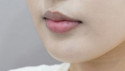 Trước khi tiêm filler môi (Kiểu môi cuộn vào trong)