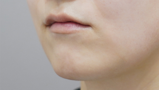 Trước khi tiêm filler môi (Kiểu môi có nhân trung dài)