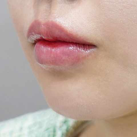 Ngay sau khi tiêm filler môi (Kiểu môi chảy xệ)