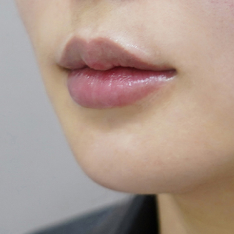 Ngay sau khi tiêm filler môi (Kiểu môi bất đối xứng)