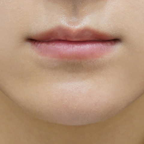 Trước khi tiêm filler môi (Kiểu môi mỏng)
