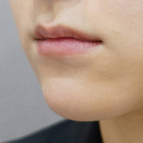 Trước khi tiêm filler môi (Kiểu môi mỏng)
