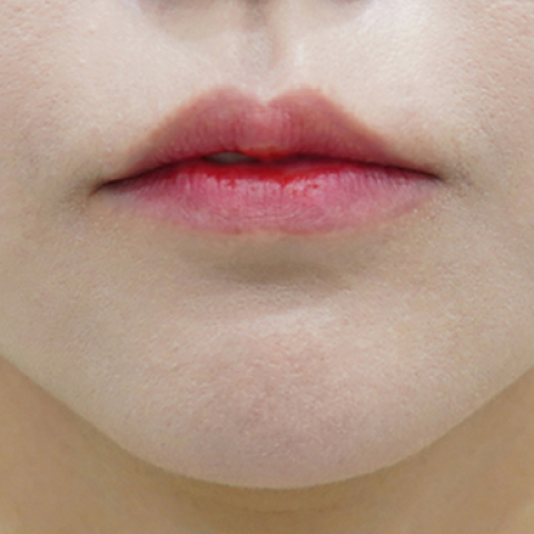 Trước khi tiêm filler môi (Kiểu môi chảy xệ)