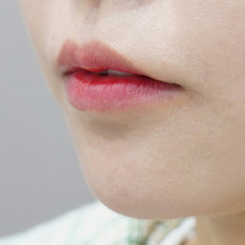 Trước khi tiêm filler môi (Kiểu môi chảy xệ)