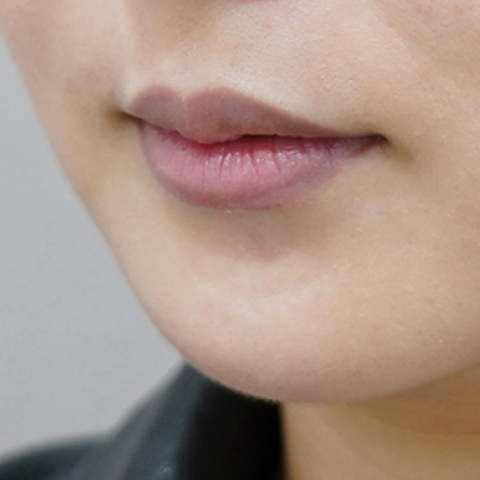 Trước khi tiêm filler môi (Kiểu môi bất đối xứng)