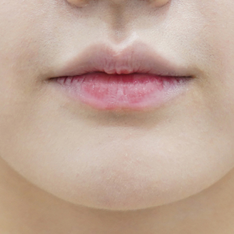 Trước khi tiêm filler môi (Kiểu môi nhỏ)
