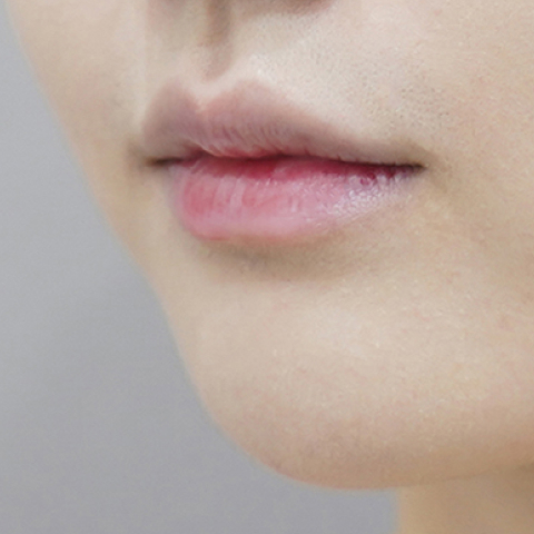 Trước khi tiêm filler môi (Kiểu môi nhỏ)