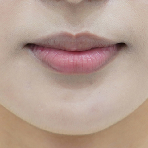 Trước khi tiêm filler môi (Kiểu môi cuộn vào trong)